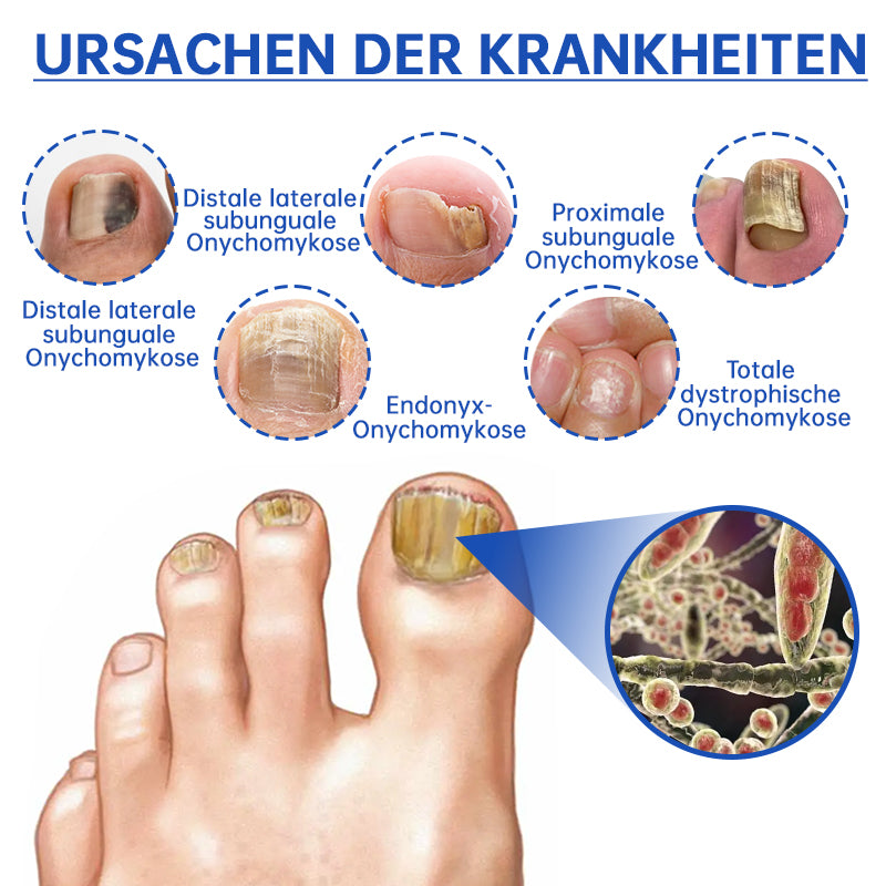 PureNail™  Die effektive Lösung gegen Nagelpilz – Für gesunde, schöne Nägel