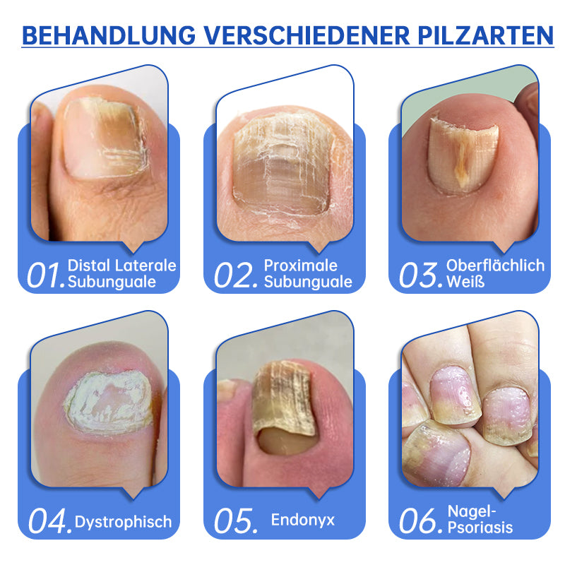 PureNail™  Die effektive Lösung gegen Nagelpilz – Für gesunde, schöne Nägel